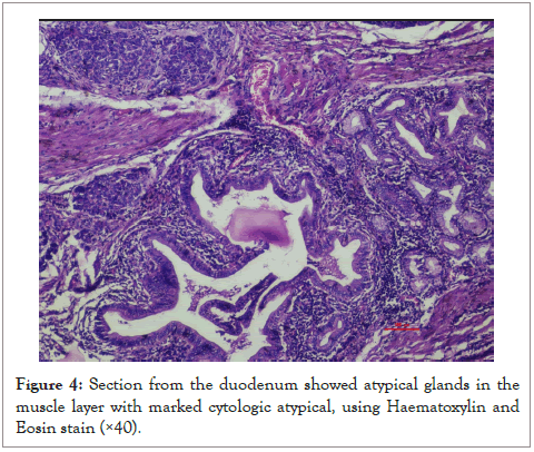 pancreatic-disorders-glands