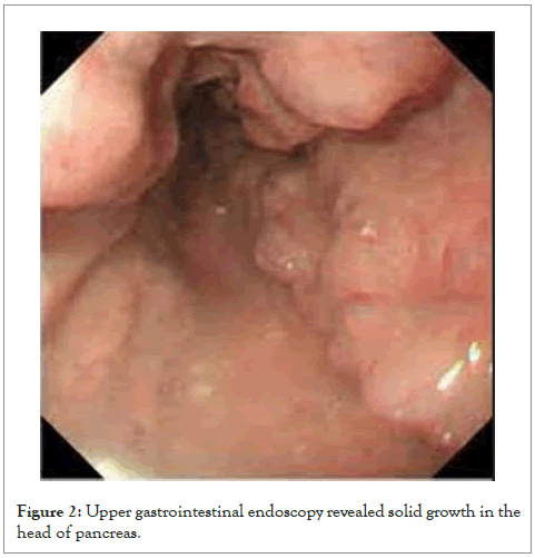 pancreatic-disorders-upper