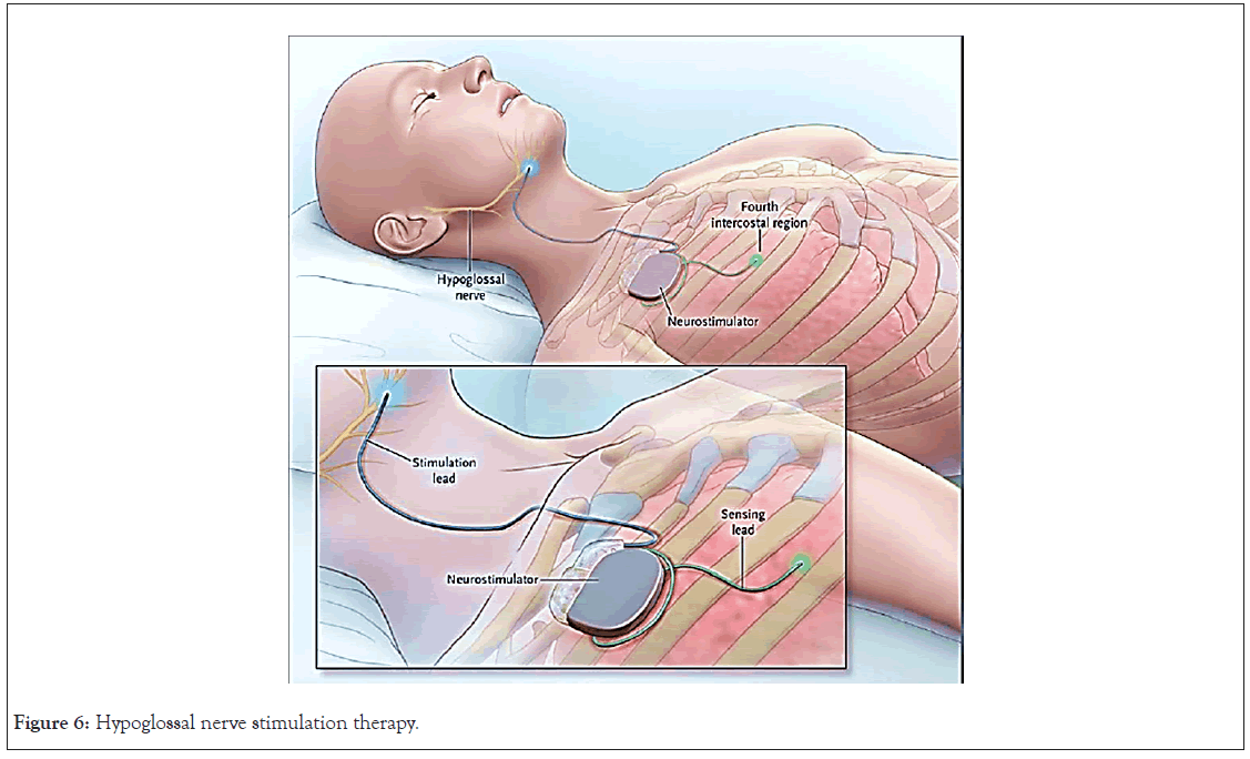 Hypoglossal