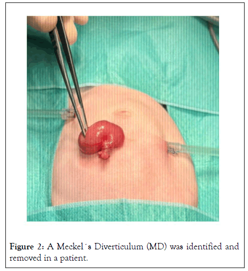 Diverticulum