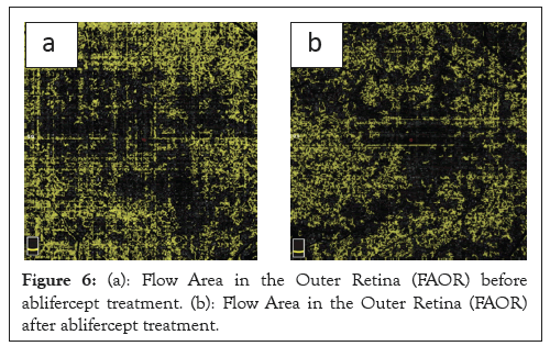 Retina