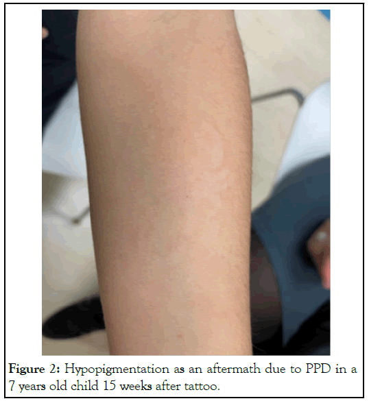 Hypopigmentation