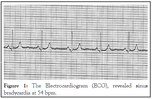 Electrocardiogram