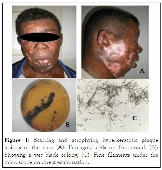 fungal-genomics-hyperkeratotic