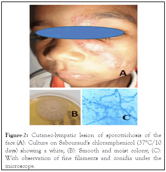 fungal-genomics-sporotrichosis