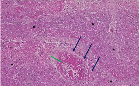 ajrm-lung