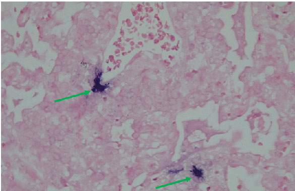 ajrm-lung