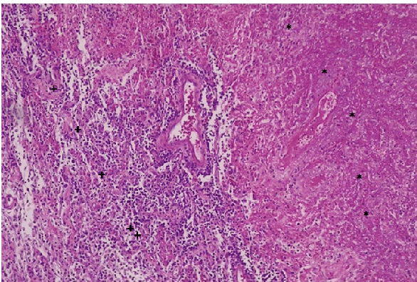 ajrm-lung