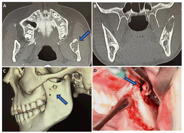 mrcs-3d