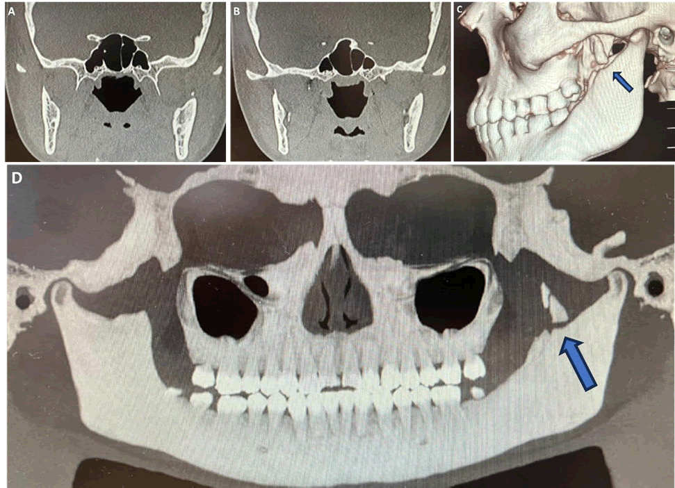 mrcs-3d