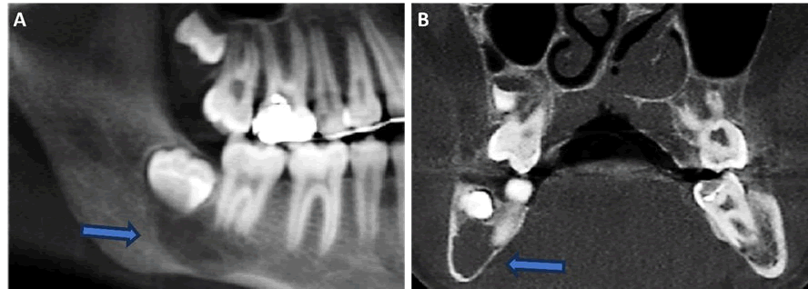 mrcs-3d