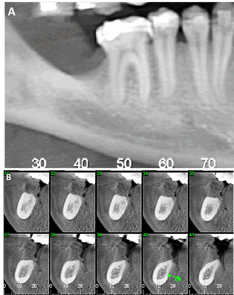 mrcs-3d