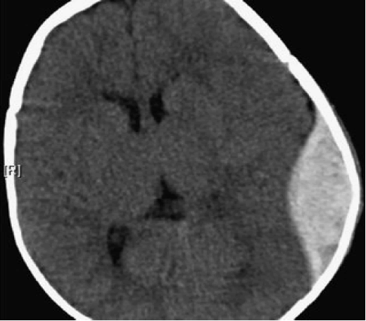 mrcs-ct