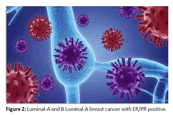 oncologyradiotherapy-breast-cancer