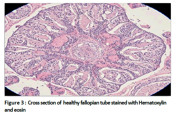 oncologyradiotherapy-breast-cancer