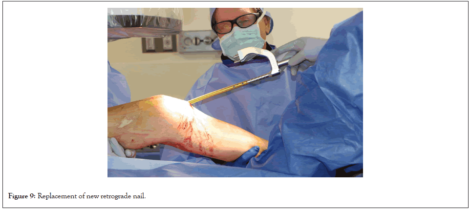 Soft tissue loss around knee