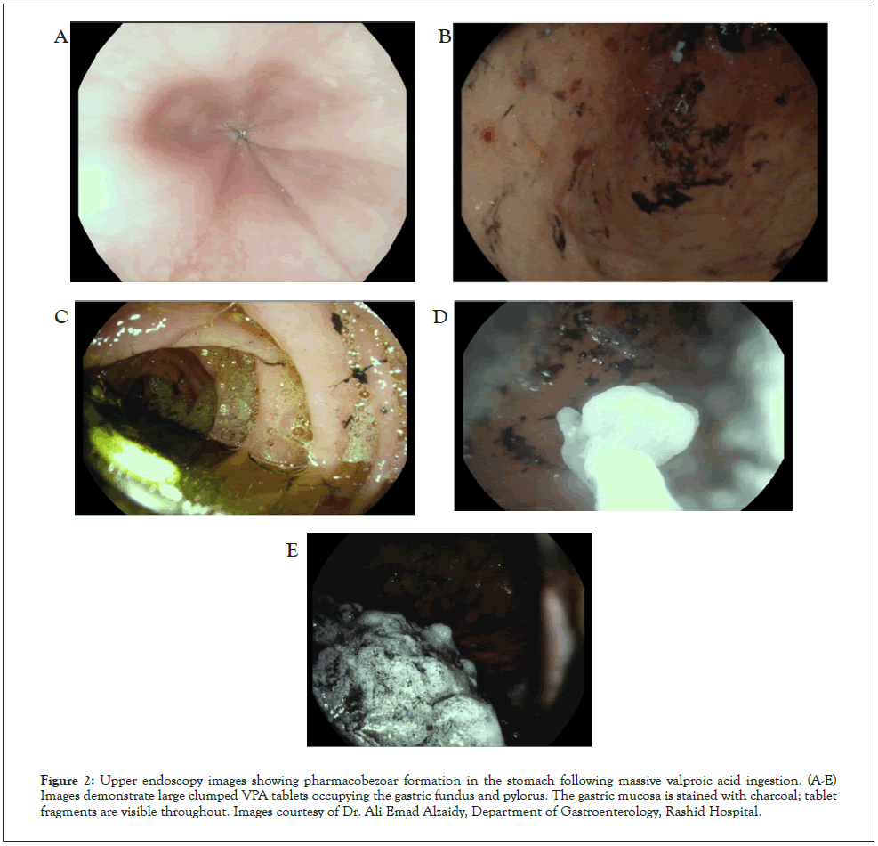 l carnitine for valproic acid toxicity Frontiers Navigating the Edge: Acute Psychiatric