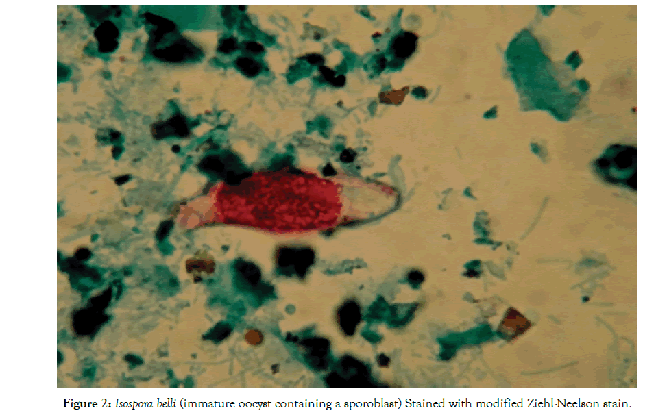 Incidence of Isospora belli in Leukemic Children in Erbil City