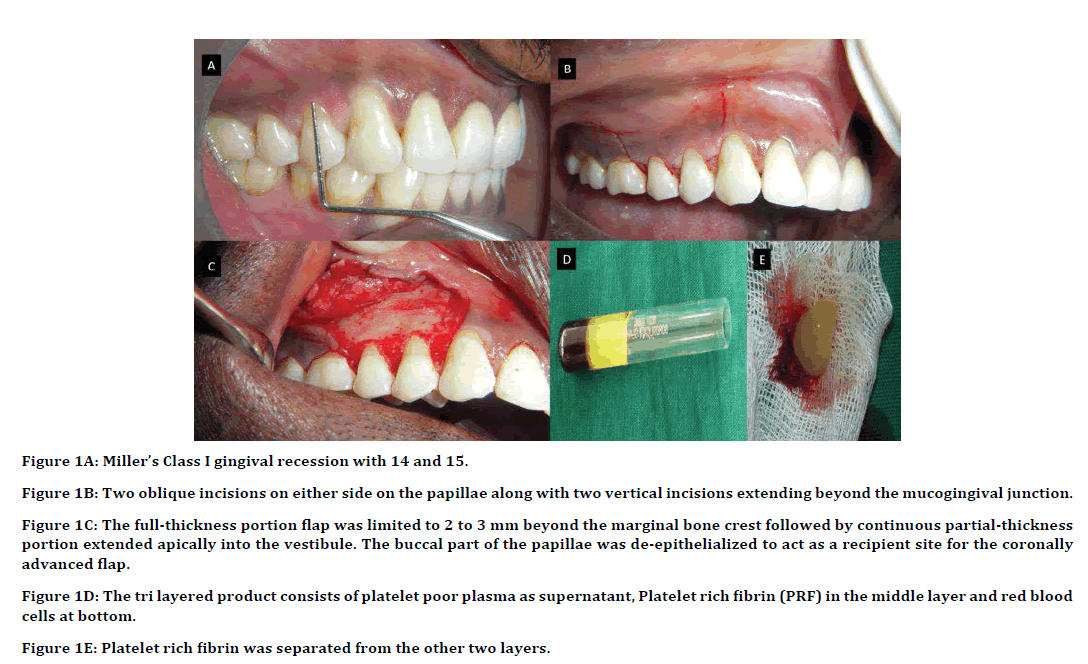 Dental-Science-gingival