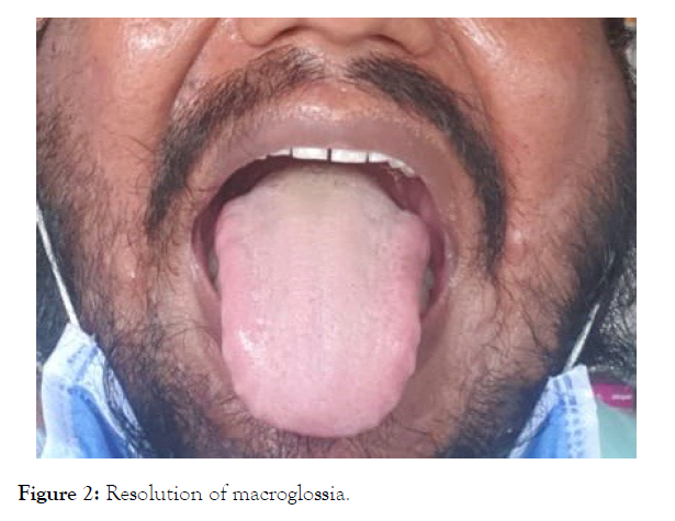 Endocrinology-Metabolic-Syndrome-Resolution-macroglossia