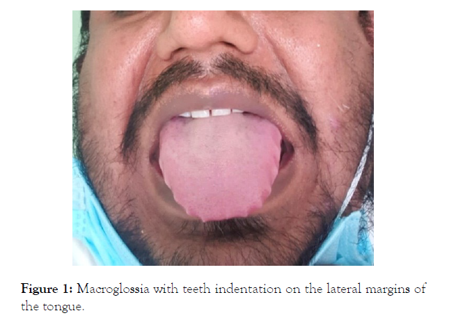 Endocrinology-Metabolic-Syndrome-teeth-indentation