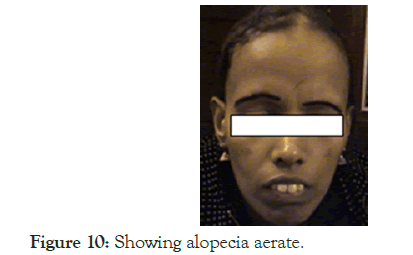 Lupus-alopecia