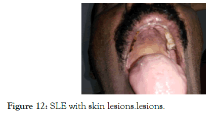 Lupus-lesions