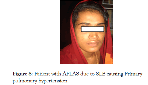 Lupus-pulmonary