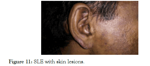 Lupus-skin