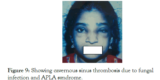 Lupus-thrombosis