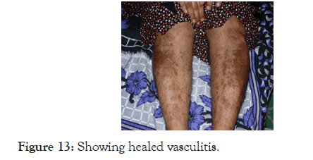 Lupus-vasculitis