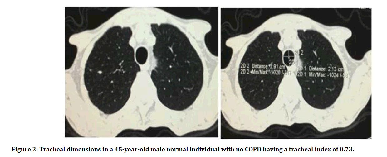 Medical-Dental-COPD-tracheal