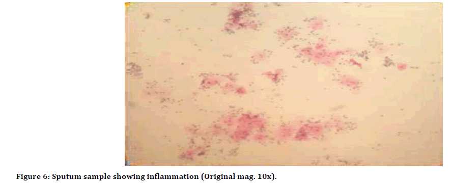 Medical-Dental-Sputum-sample