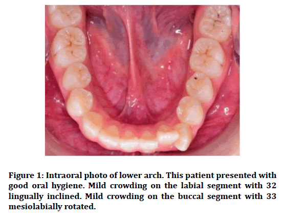Medical-Dental-lingually-inclined