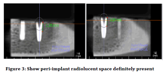 Medical-dental-implant-radiolucent