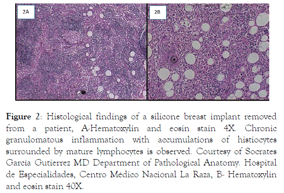 Rheumatology-biopsy-inflammation