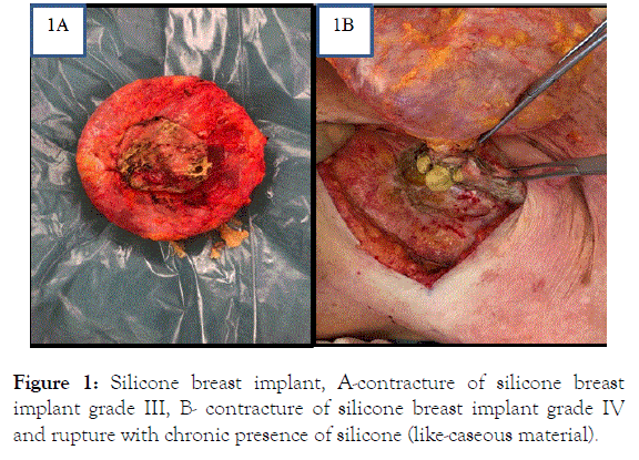 Rheumatology-biopsy-silicone