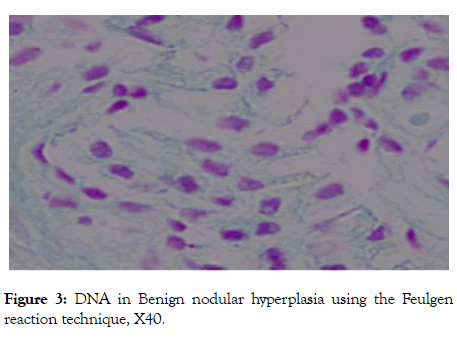 andrology-nodular-hyperplasia