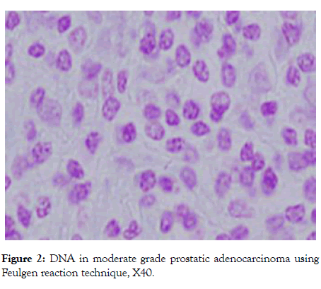 andrology-prostatic-adenocarcinoma