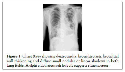 anesthesia-clinical-dextrocardia