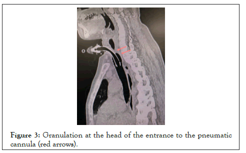 anesthesia-clinical-granulation