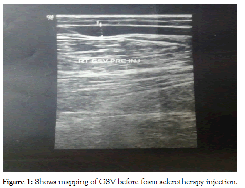 angiolog-foam-sclerotherapy