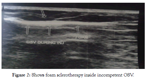 angiolog-sclerotherapy-inside