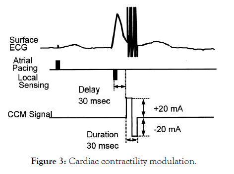 angiology-cardiac-contractility-modulation