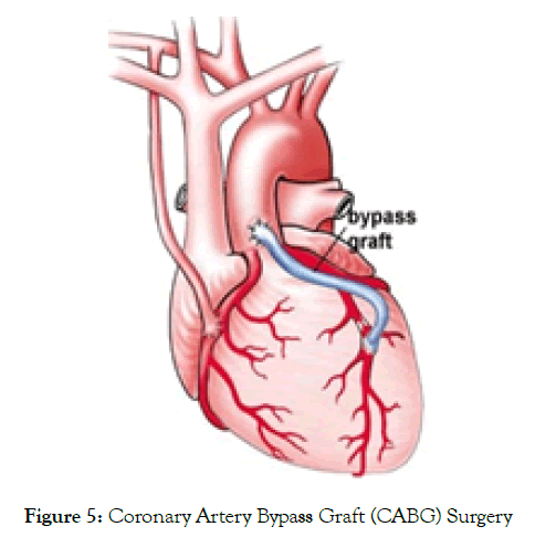 angiology-coronary-artery-bypass