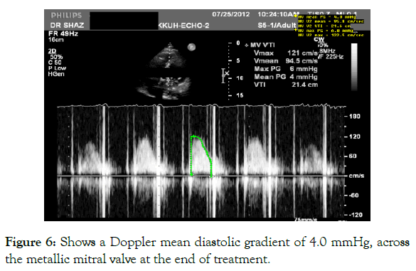 angiology-doppler-diastolic-gradient