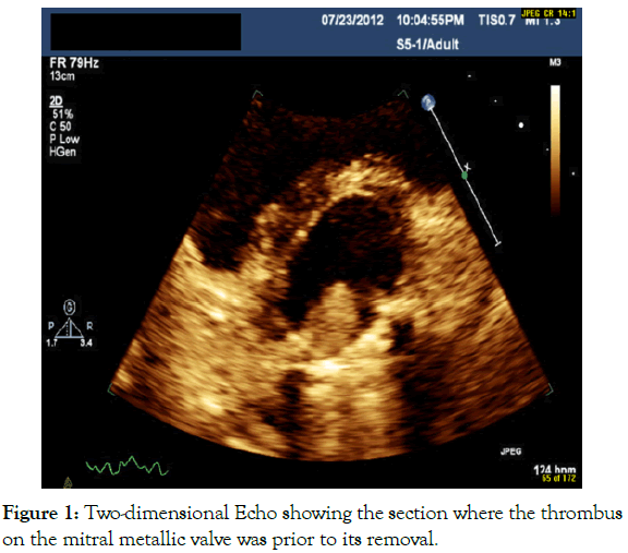 angiology-echo-mitral-metallic