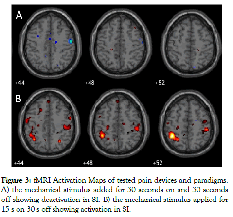 biomedical-engineering-fMRI-Activation