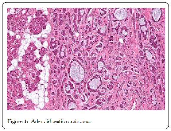 cancer-research-cystic