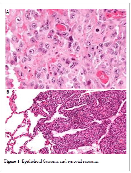 cancer-research-immuno-Sarcoma